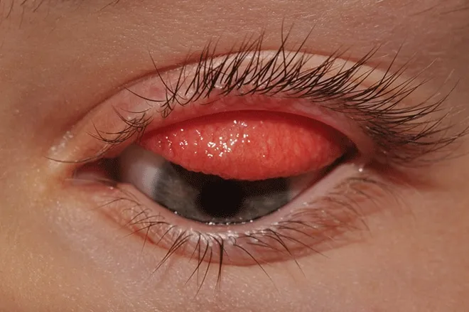 Giant Papillary Conjunctivitis in Contact Lens Wearer
