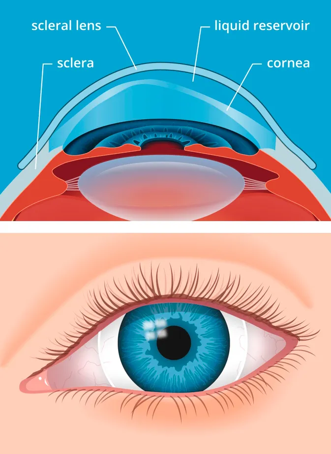 Scleral lens fitting for keratoconus