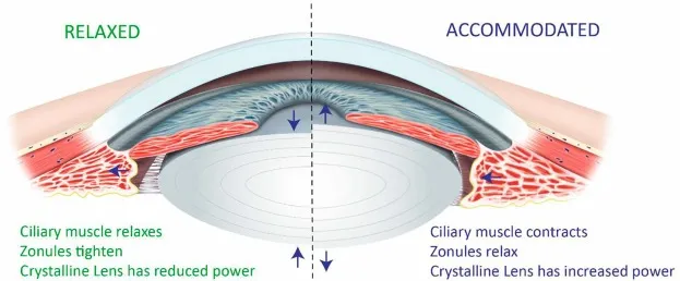 Eye accommodation: relaxed vs. accommodated lens