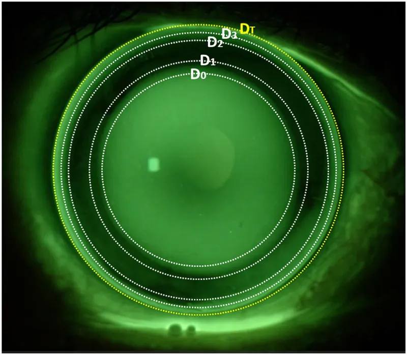Fluorescein pattern with RGP lens on eye