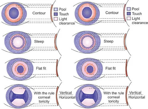 RGP fluorescein patterns on different corneal shapes
