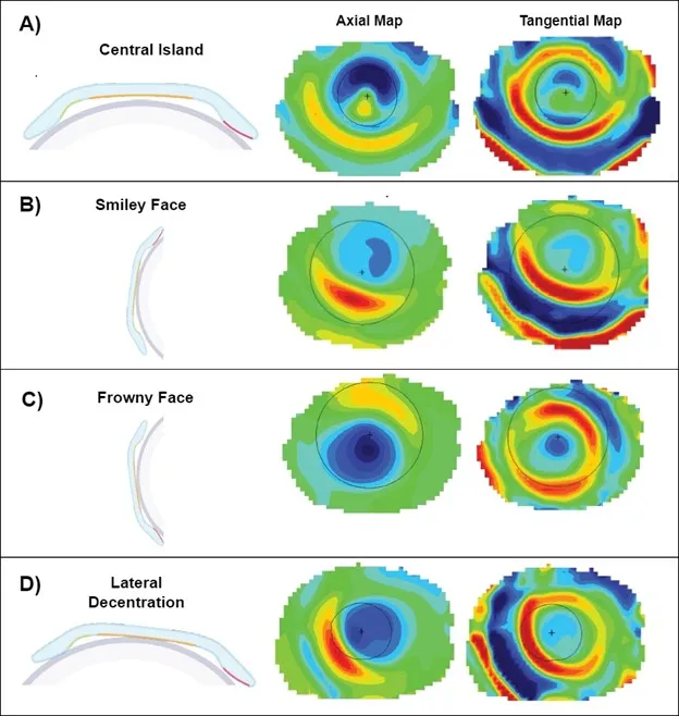 Corneal topography maps showing Ortho-K effects