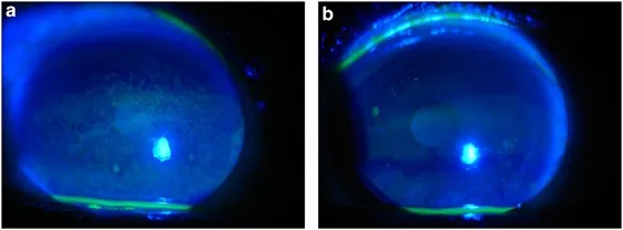 Diffuse punctate epithelial erosions on fluorescein staining