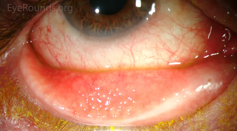Follicular reaction in viral conjunctivitis