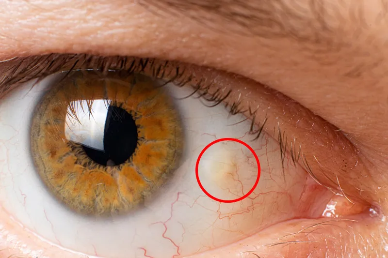 Pinguecula on conjunctiva