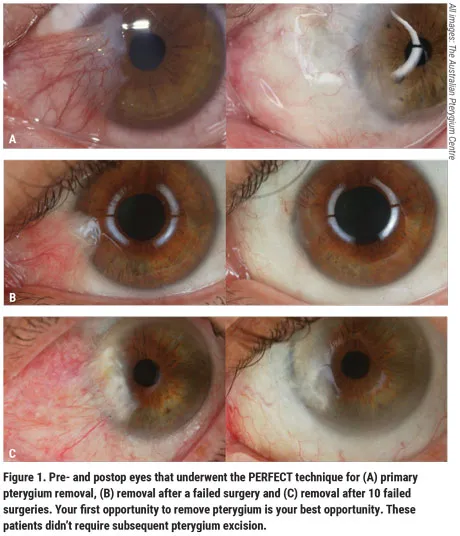 Pre- and post-op pterygium removal (PERFECT technique)