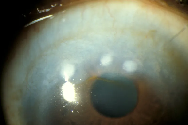 Salzmann Nodular Degeneration