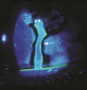 Positive Seidel test indicating corneal perforation