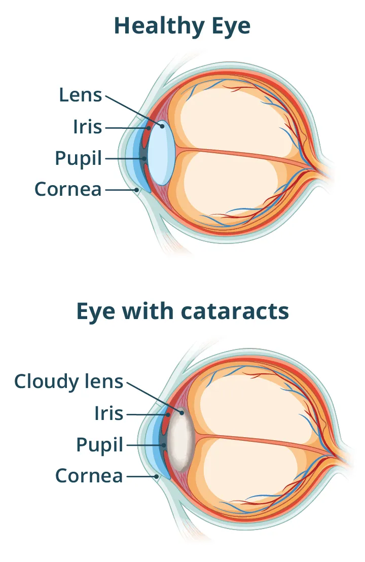 Healthy eye vs. eye with cataracts