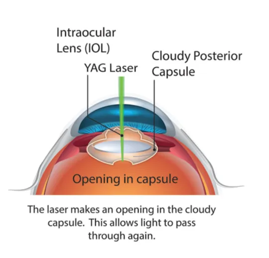 YAG laser capsulotomy for PCO