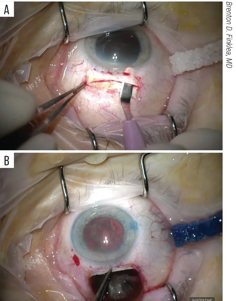 SICS steps: scleral tunnel and nucleus delivery