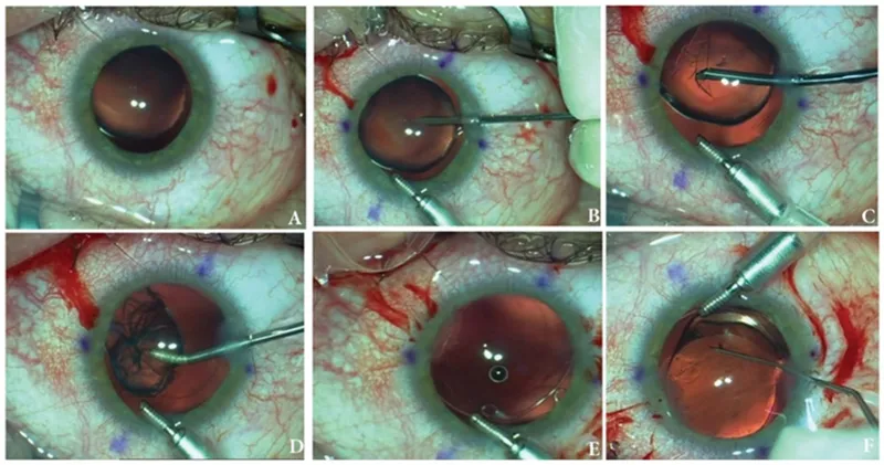 Lensectomy with IOL placement in infant eye