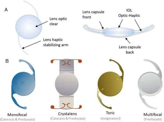 Intraocular Lens (IOL) Components and Types