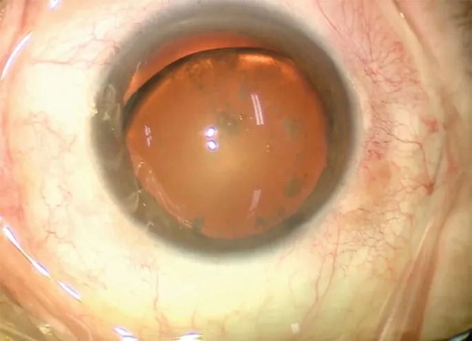 Lens Subluxation with Aphakic Crescent Sign