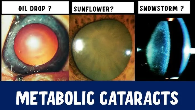 Metabolic Cataracts: Oil Drop, Sunflower, Snowstorm