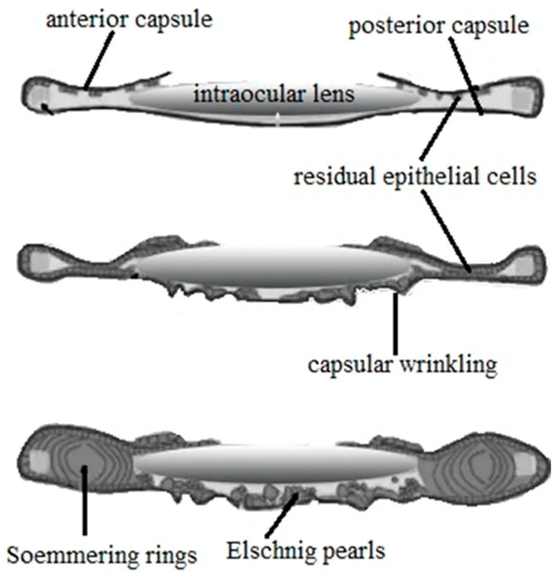 PCO progression with Elschnig pearls & Soemmering rings