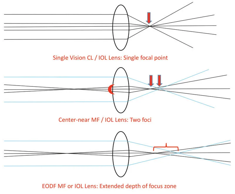 Light focus paths for Monofocal, Multifocal, EDOF IOLs