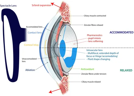 Aspheric, Accommodating, and Phakic IOLs Diagram