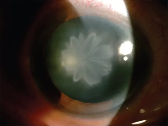 Traumatic Rosette Cataract