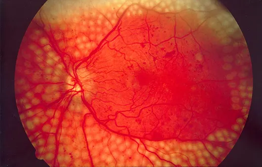 Fundus with PRP laser scars