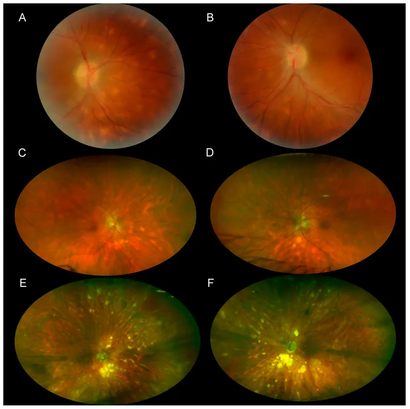 Fundus images showing birdshot lesions in chorioretinopathy