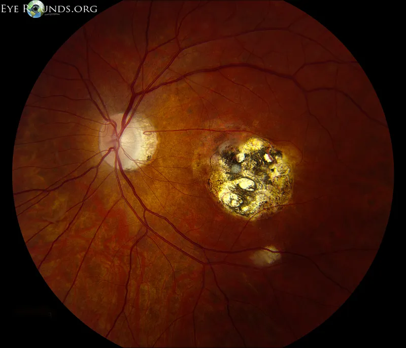 Fundus photo: Posterior uveitis with chorioretinal lesion