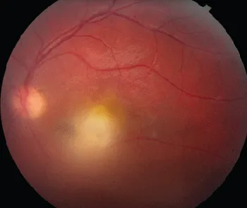 Fundus of toxoplasmic retinochoroiditis