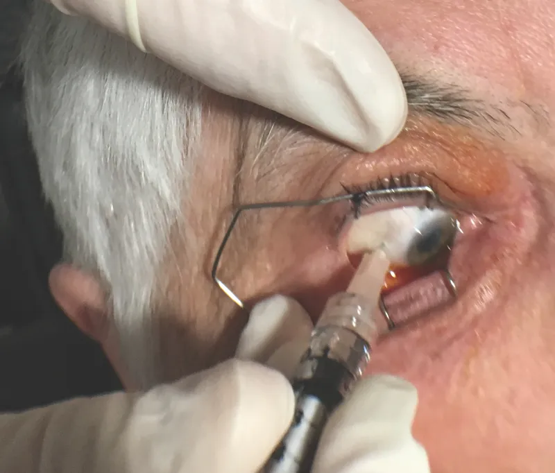 Intravitreal injection procedure
