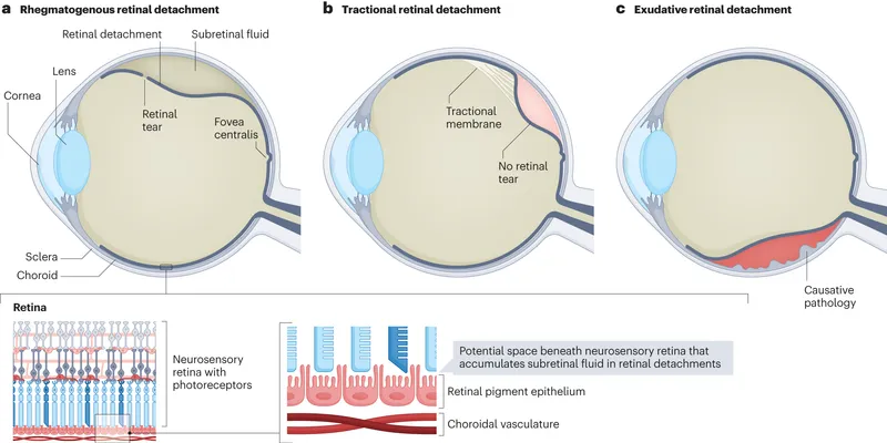Types of Retinal Detachment