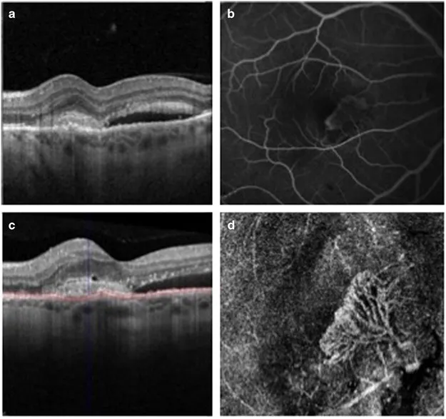 OCT, FFA, and OCTA of choroidal neovascularization