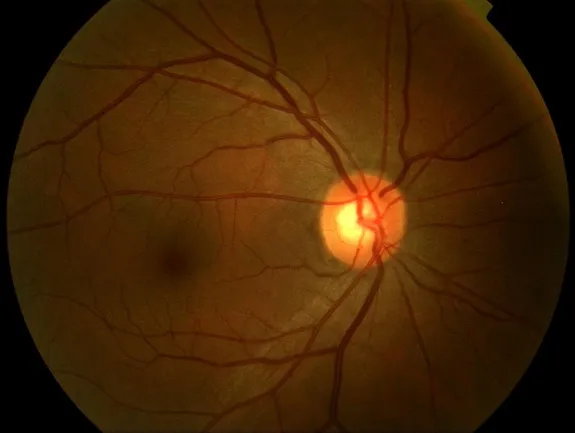 Fundus photograph of normal retina