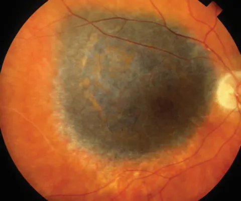 Fundus photo of choroidal melanoma