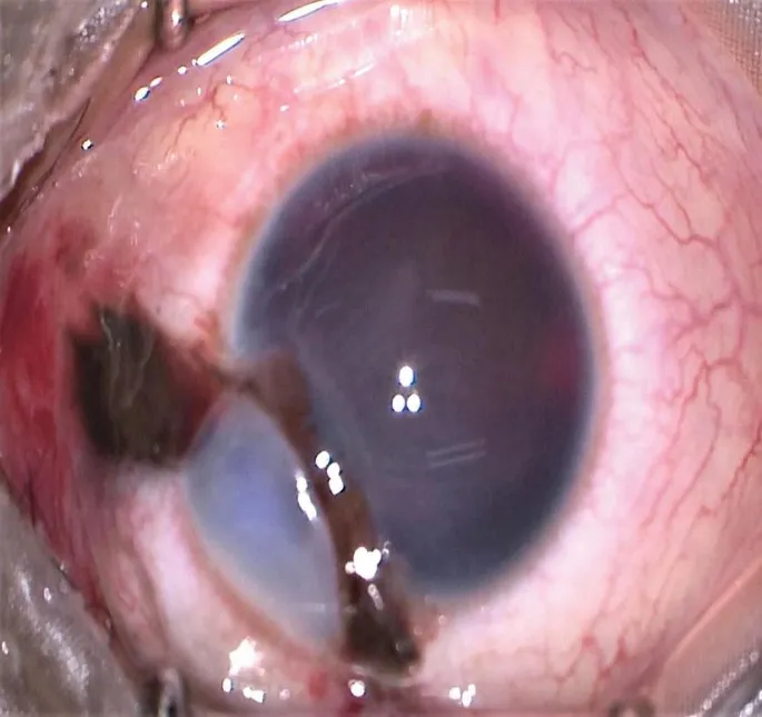 Scleral trauma with iris prolapse