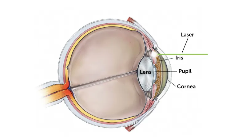 Laser Iridotomy Target Area on Iris Anatomy