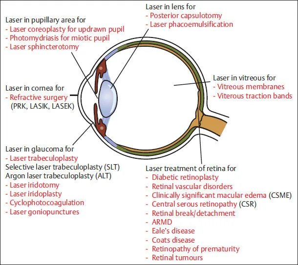 Laser treatments for eye conditions