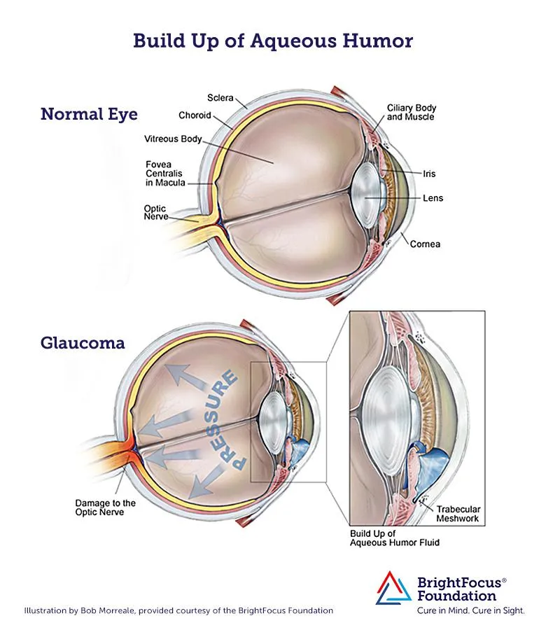 Aqueous Humor Build Up in Glaucoma
