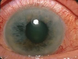 Acute angle closure glaucoma eye