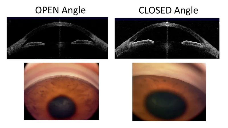 Open vs Closed Angle OCT and Gonioscopy