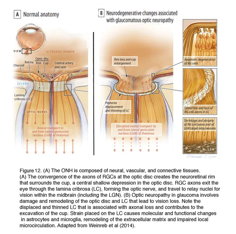 Optic nerve changes in glaucoma