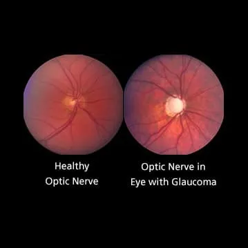Healthy vs Glaucomatous Optic Nerve