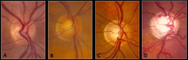 Optic disc cupping progression