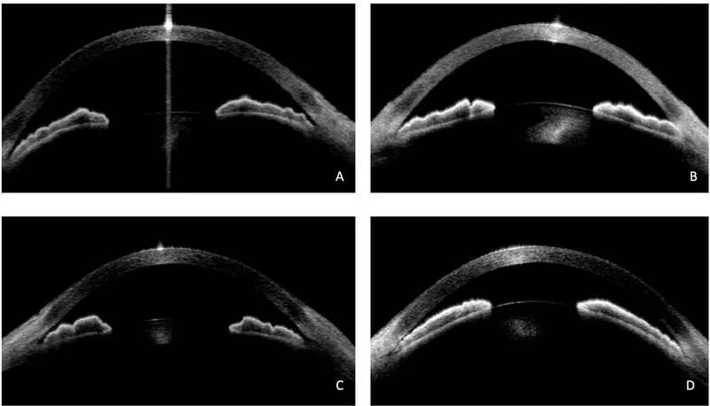 UBM of posterior pushing mechanism in angle closure