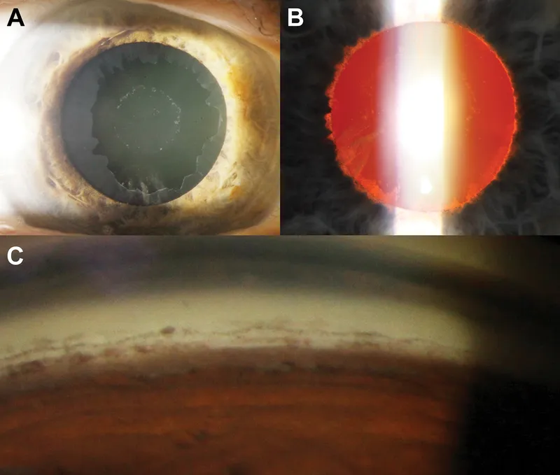 Exfoliation syndrome anterior lens capsule bull's-eye sign