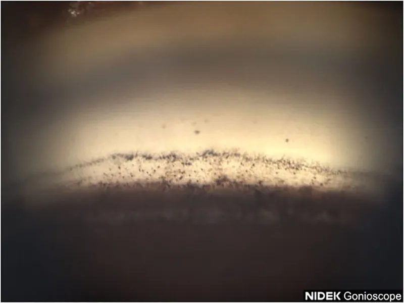 Gonioscopy of pigment dispersion in trabecular meshwork