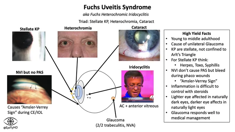 Fuchs Uveitis Syndrome Triad and Glaucoma