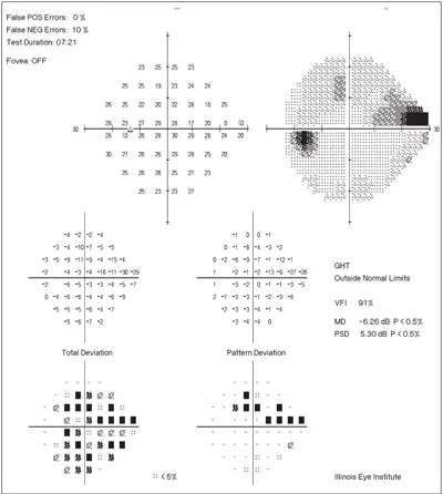 Humphrey visual field report with indices