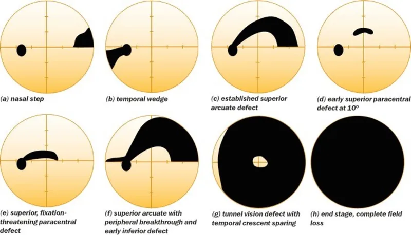 Glaucomatous visual field defects