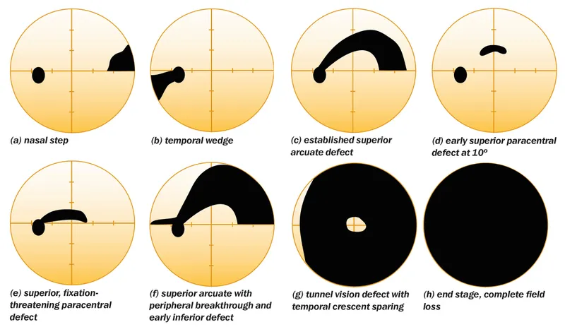Glaucomatous visual field defect schematic