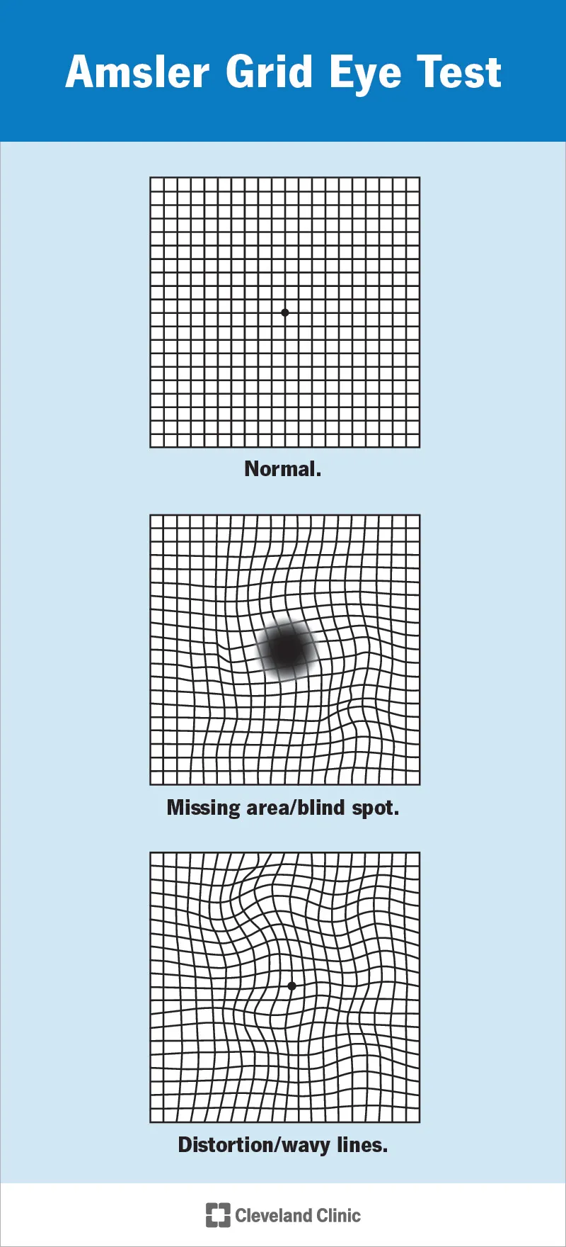 Amsler Grid: Normal, Blind Spot, Distortion