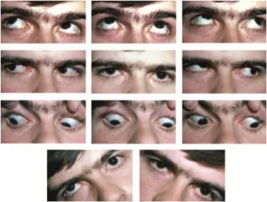 Parks-Bielschowsky test for CN IV palsy